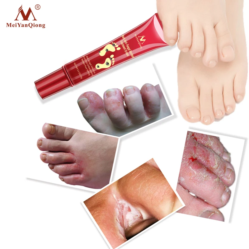 Glivične Zdravljenje Foot Cream anti Okužbe Razbremeniti Srbenje Onychomycosis Paronychia Toe Glive Popravila Suho Crack Noge, Nego 15g