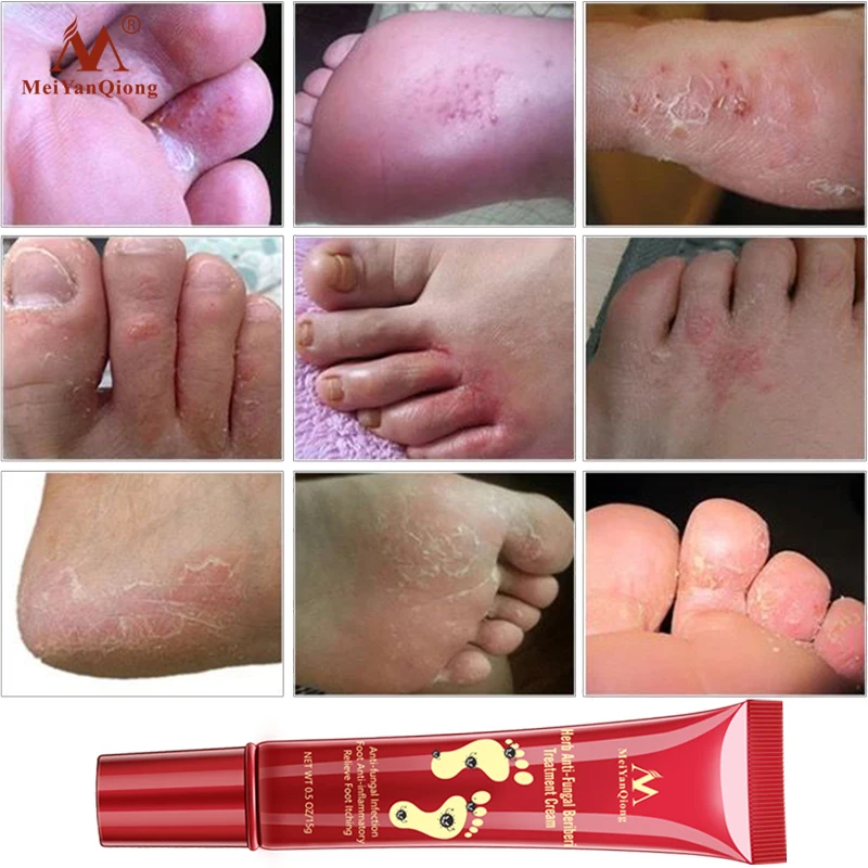 Glivične Zdravljenje Foot Cream anti Okužbe Razbremeniti Srbenje Onychomycosis Paronychia Toe Glive Popravila Suho Crack Noge, Nego 15g